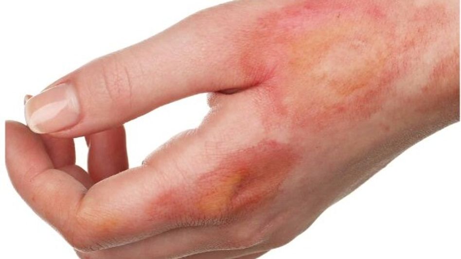 SKIN BURN SKIN BURN