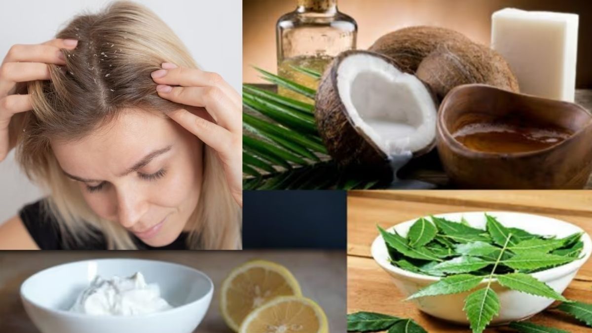 Dandruff Home Remedy