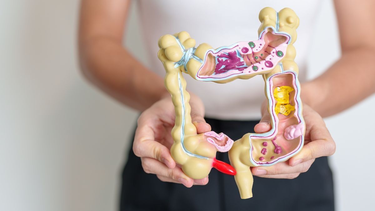 कोलन कैंसर 