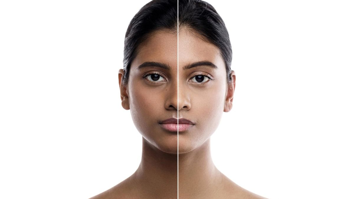 Skin Whitening Treatment: Photo: Getty