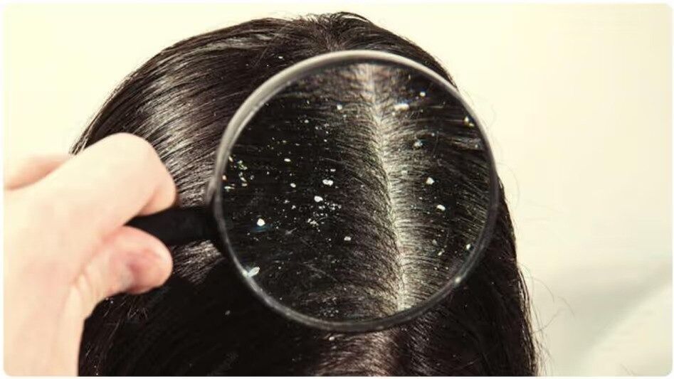 Dandruff
