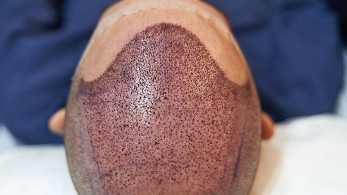 हेयर ट्रंसप्लांट