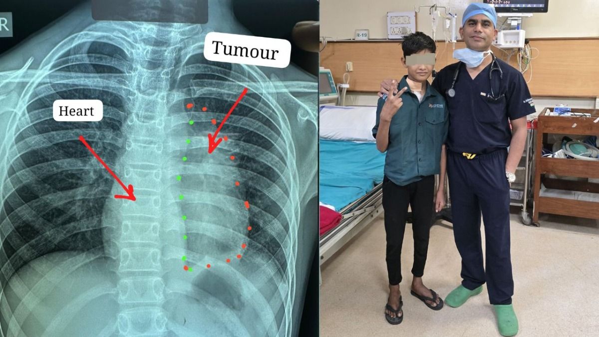 rare heart-attached cancer surgery at Mekahara