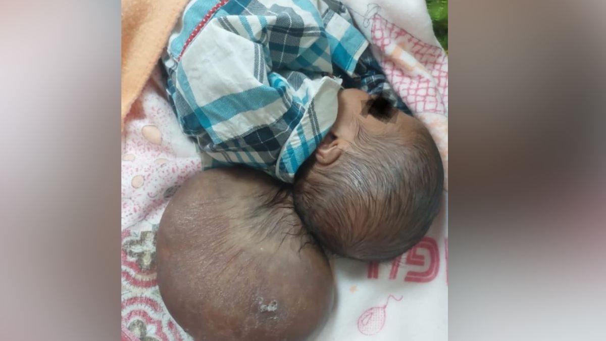 Rare Brain Condition Surgery 