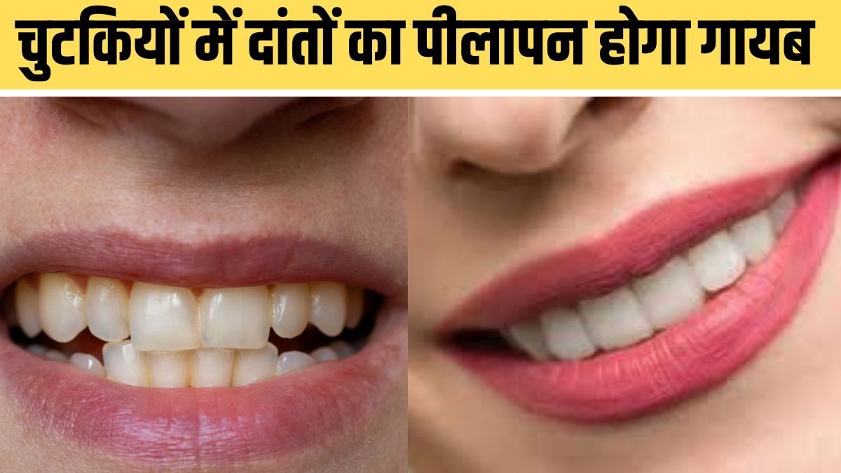 How to Whiten Yellow Teeth