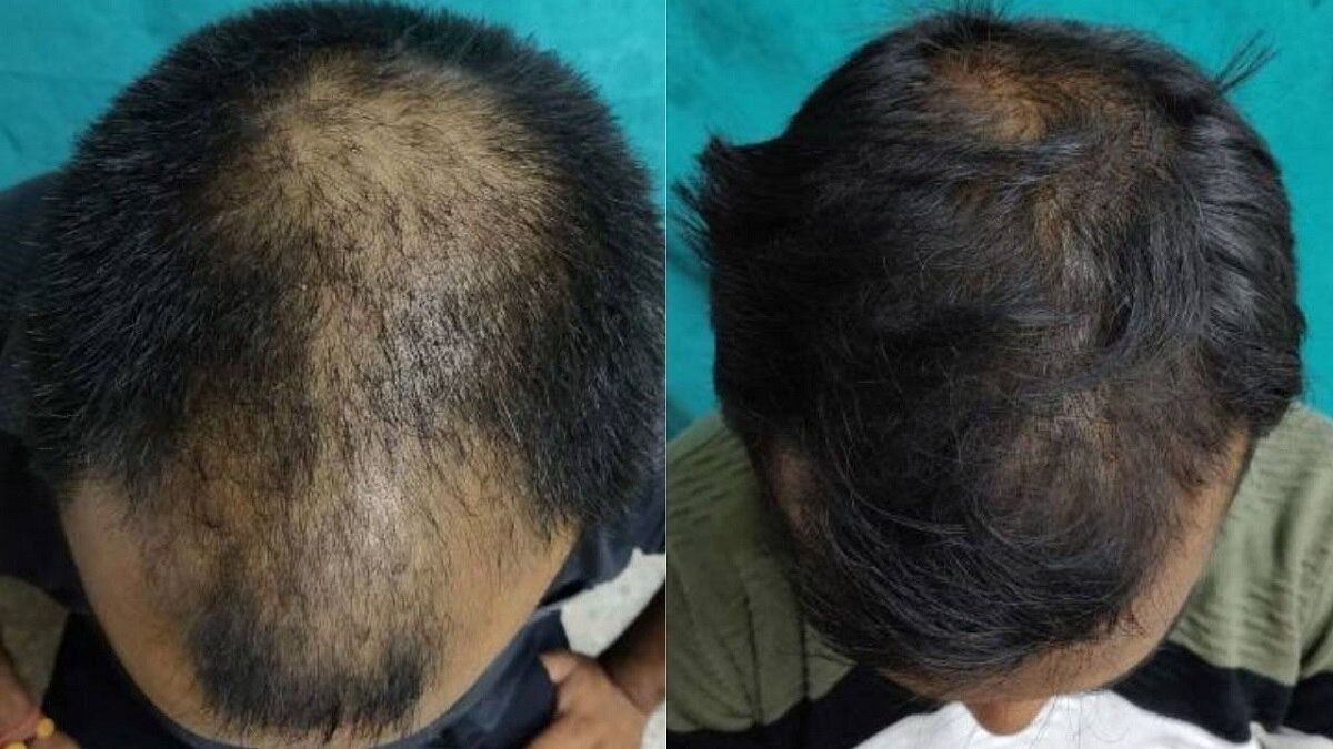 Baldness Treatment