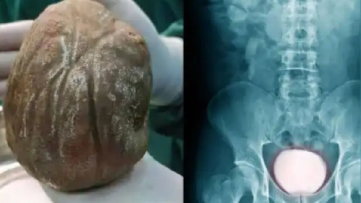 giant bladder stone