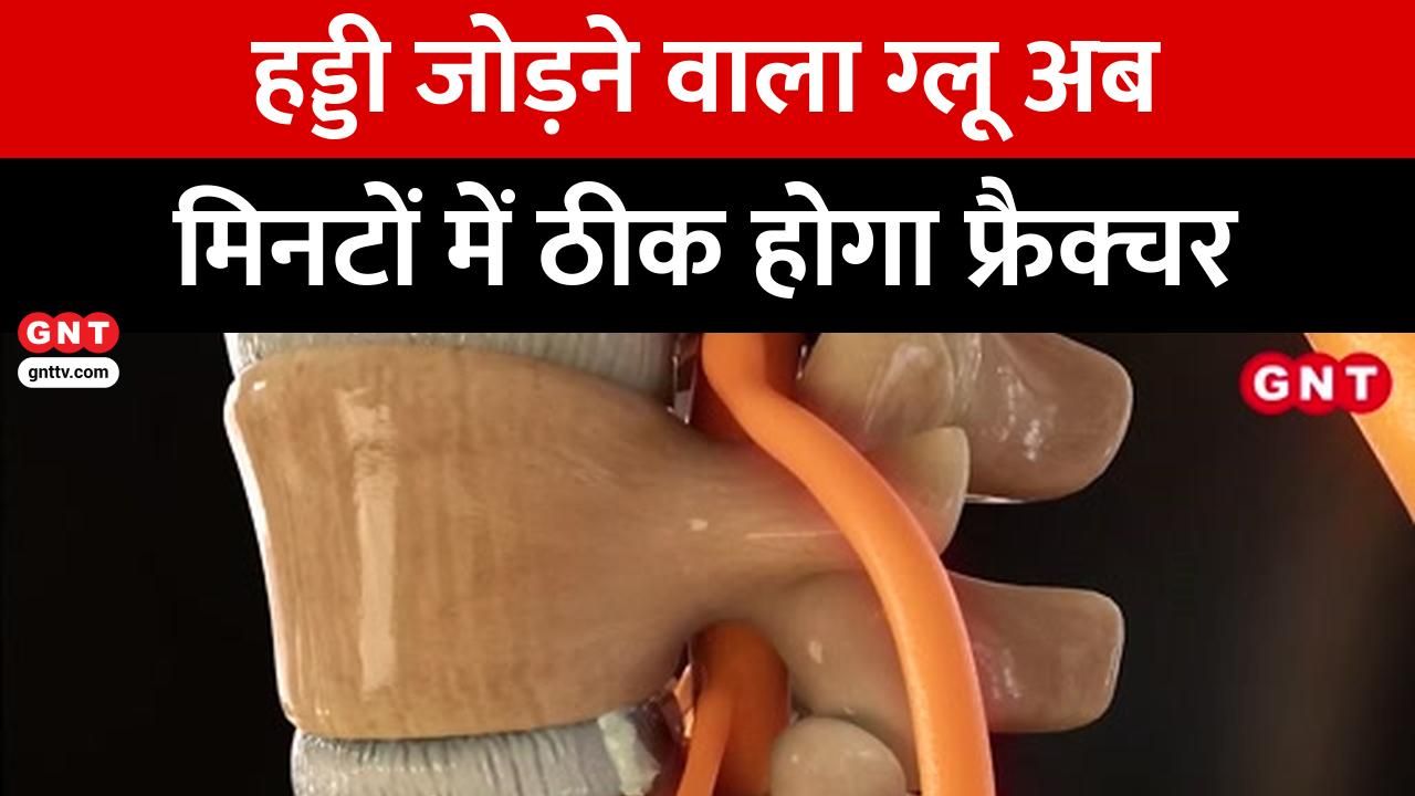 Puro Report: China's new medical glue heals broken bones in minutes, allowing immediate mobility and avoiding metal implants frvd