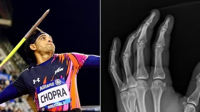 नीरज चोप्राचा हात तुटला