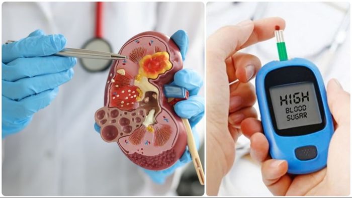 ডায়াবেটিস কিডনির ক্ষতি করতে পারে, জেনে নিন প্রতিরোধের উপায়
