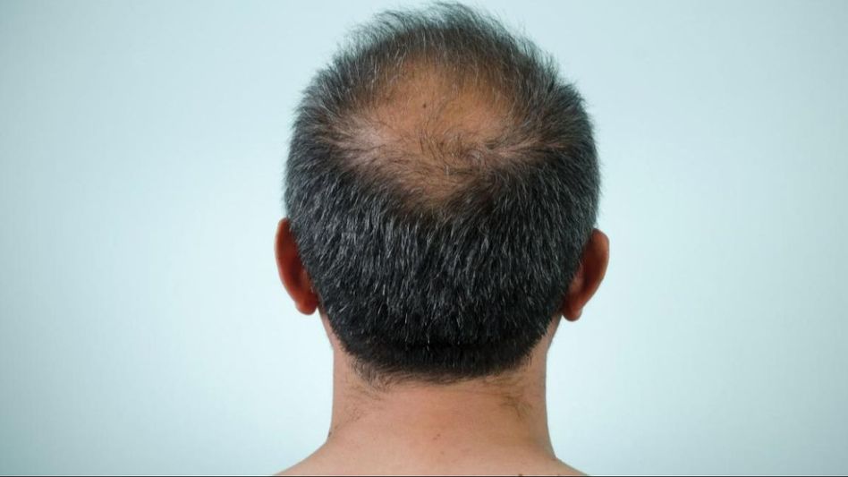Baldness Baldness