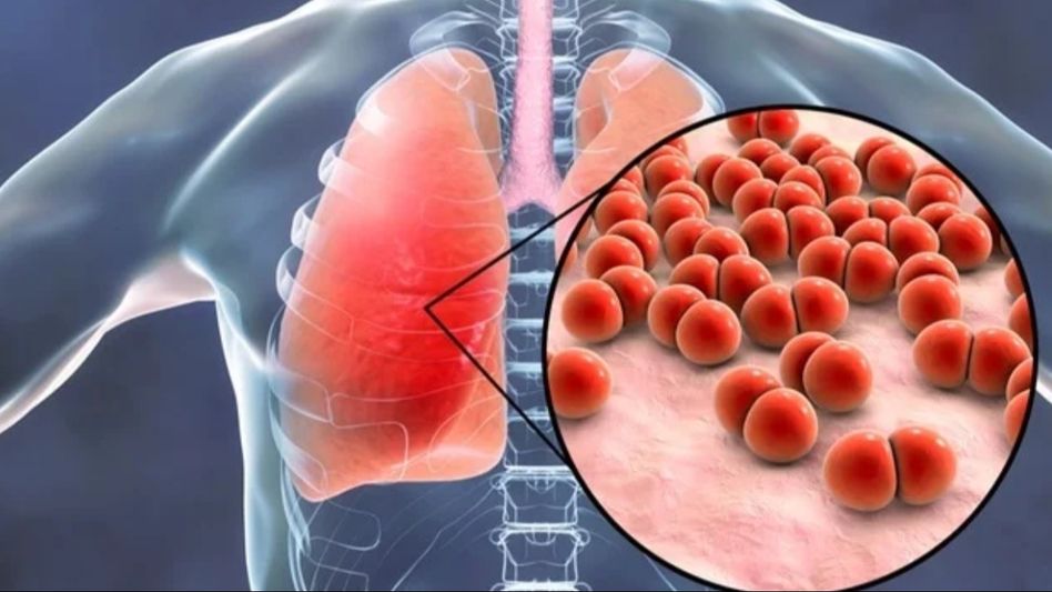 Winters and Pneumonia Winters and Pneumonia