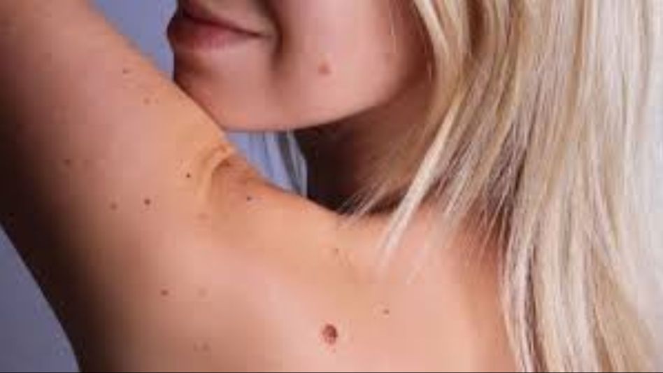 Melanoma Vaccine Melanoma Vaccine