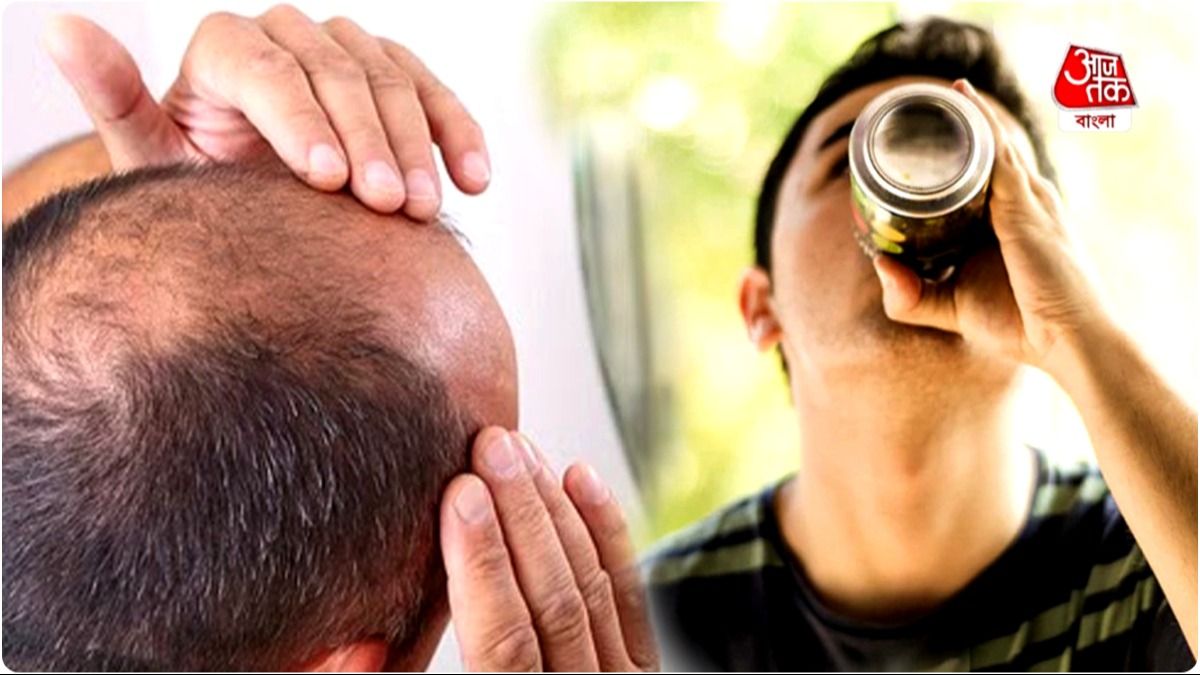 Unknown Causes Of Baldness এই পানীয় অজান্তেই বাড়িয়ে দিচ্ছে টাক