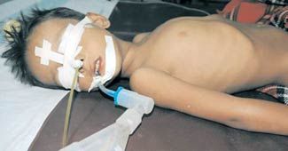 इंसेफेलाइटिस