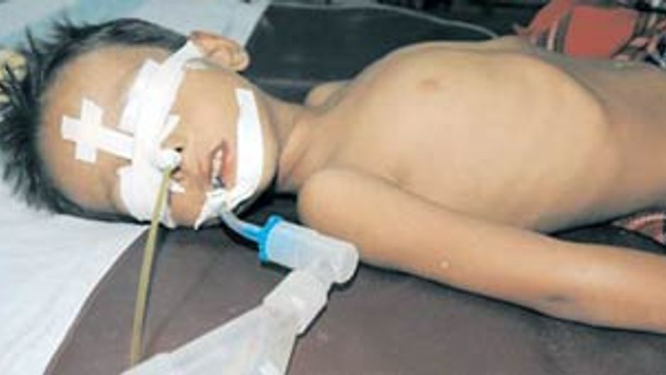 इंसेफेलाइटिस