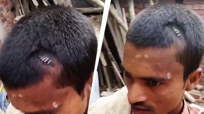 Stapler Pins Used Instead of Stitches