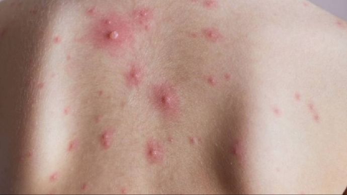 Chicken Pox: കേരളത്തിൽ ചിക്കൻപോക്സ് പടരുന്നു; ലക്ഷണങ്ങൾ കണ്ടാലുടൻ ചികിത്സ തേടണമെന്ന് ആരോഗ്യ വകുപ്പ് - health department has warned about the spread of chicken pox ...