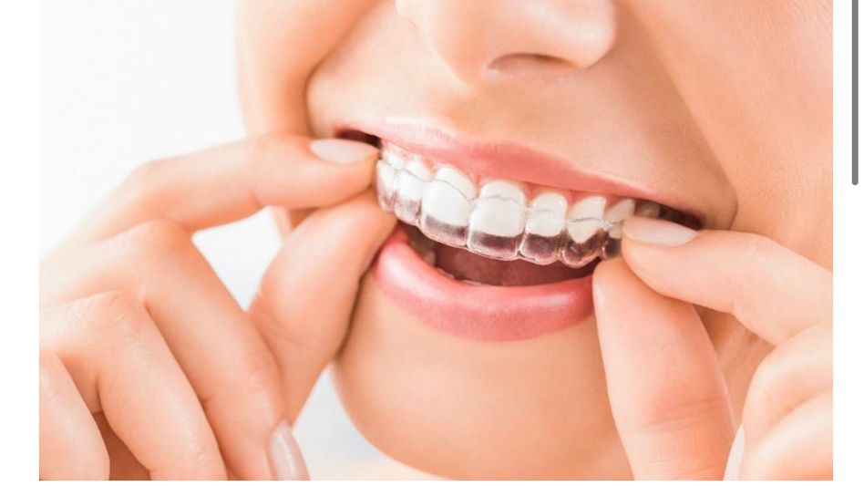 Know All About Features and Costs of Braces in India Know All About Features and Costs of Braces in India