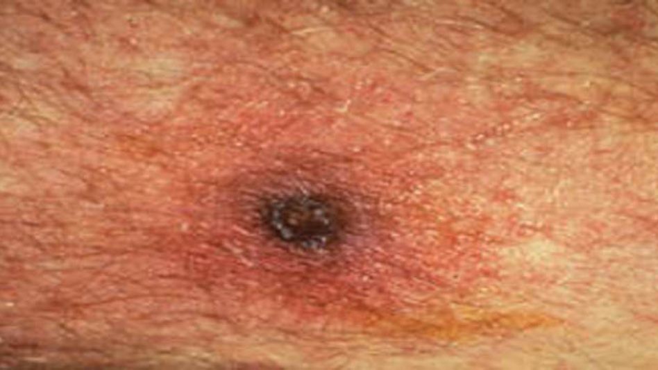 FOUR DIE IN SCRUB TYPHUS INFECTION IN MIZORAM FOUR DIE IN SCRUB TYPHUS INFECTION IN MIZORAM