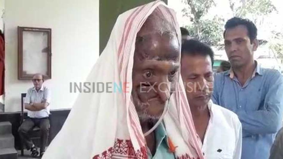 Cancer no obstacle for Guwahati voter who heads to booth despite sickness Cancer no obstacle for Guwahati voter who heads to booth despite sickness