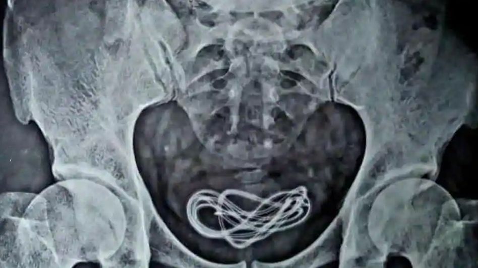 Assam: Man uses mobile charger for self-pleasure, doctors find it in urinary bladder Assam: Man uses mobile charger for self-pleasure, doctors find it in urinary bladder