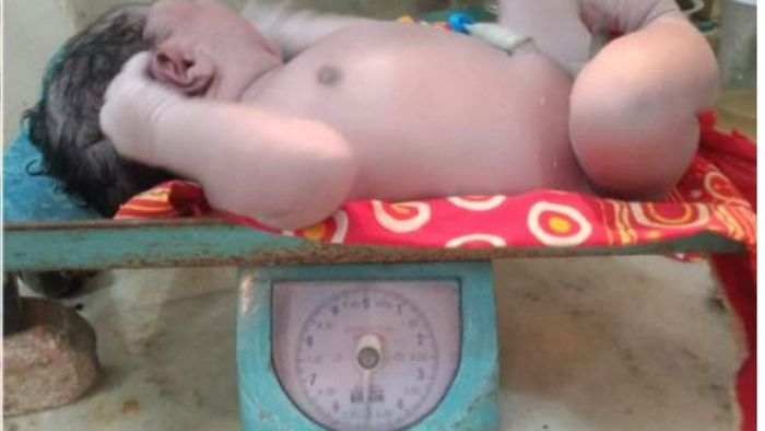 Assam: Woman gives birth to baby weighing 5.32kg; doctors claim it a state record