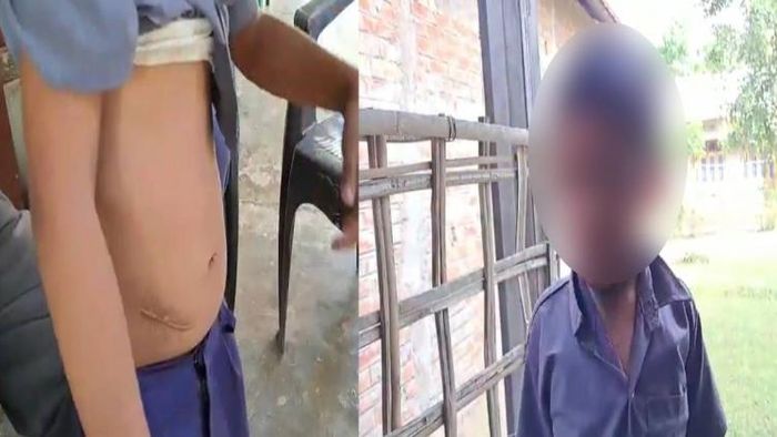 Assam: The class 1 student showing off his bruises after being thrashed by the school headmaster