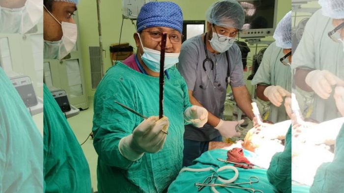 Tripura doctors successfully removes sharp iron rod from man’s face