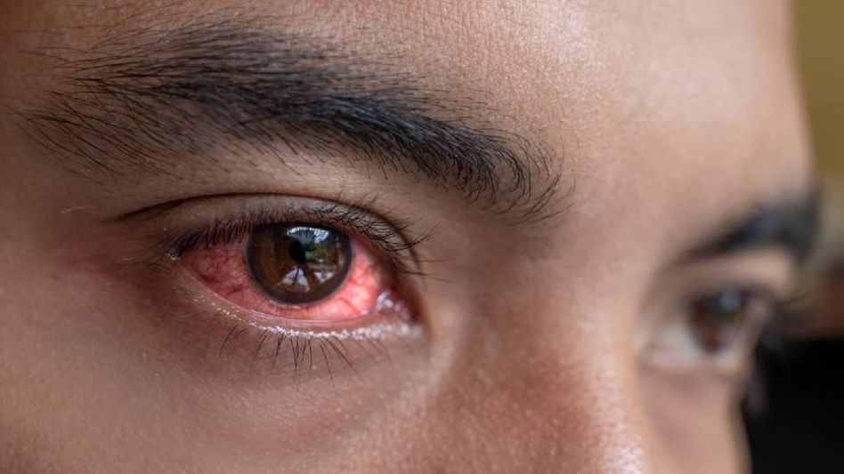 Nagaland issues advisory on conjunctivitis outbreak in India Nagaland issues advisory on conjunctivitis outbreak in India