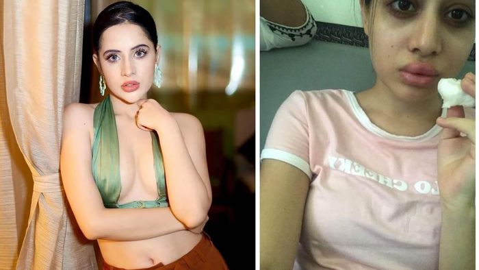 Uorfi Javed shares lip filler journey with fans