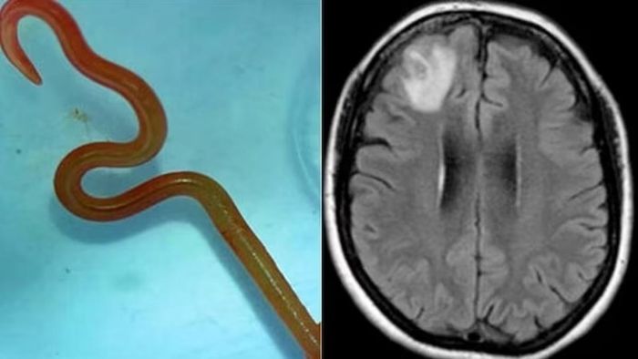 Doctors pull 8-centimetre-long live worm from patient’s brain during surgery in Australia