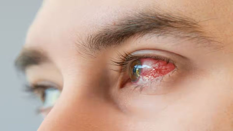 Nagaland: Three districts shut schools as conjunctivitis cases rise Nagaland: Three districts shut schools as conjunctivitis cases rise