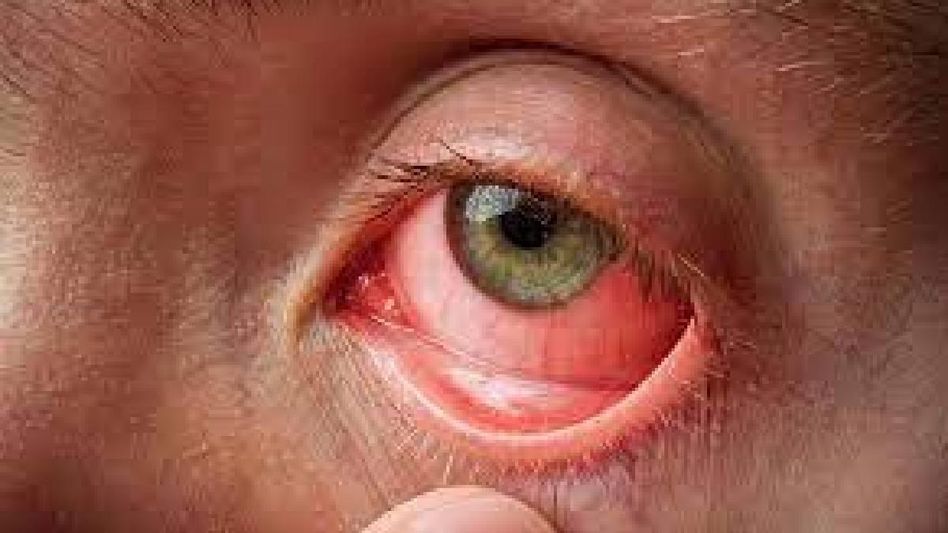 Nagaland's Health and Family Welfare department issues advisory over outbreak of Conjunctivitis in state Nagaland's Health and Family Welfare department issues advisory over outbreak of Conjunctivitis in state