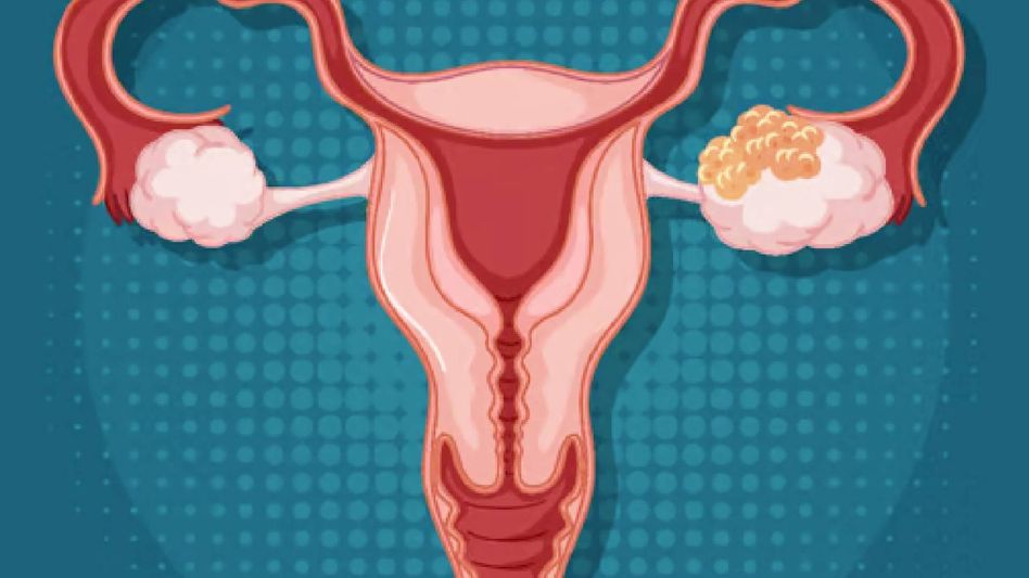 PCOD (Polycystic Ovarian Disease) : causes, symtoms, difference between PCOS and PCOD and cures PCOD (Polycystic Ovarian Disease) : causes, symtoms, difference between PCOS and PCOD and cures