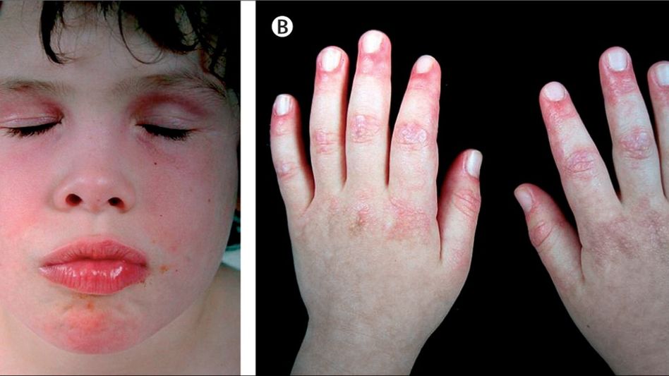 Dermatomyositis : Navigating Causes, Symptoms, and Treatment Strategies Dermatomyositis : Navigating Causes, Symptoms, and Treatment Strategies