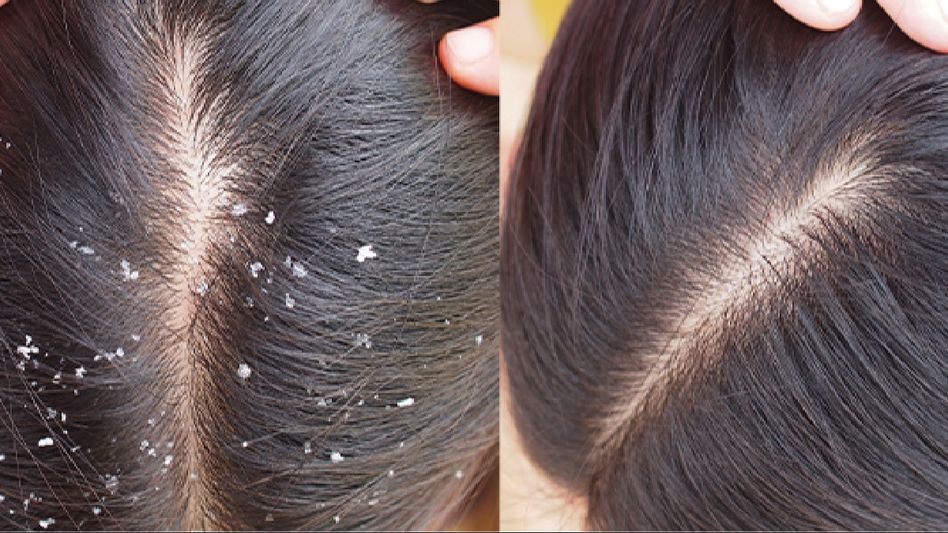 How to treat excess dandruff with home remedies How to treat excess dandruff with home remedies