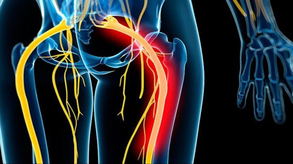 Sciatica nerve pain: Causes and symptoms Sciatica nerve pain: Causes and symptoms