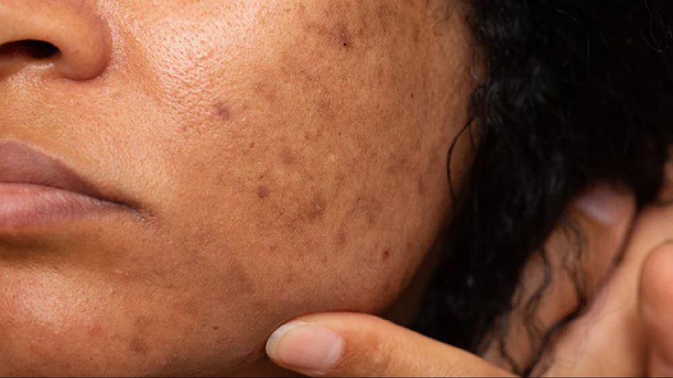 Unveiling Vitamin C: A Friend in Fading Dark Spots? Unveiling Vitamin C: A Friend in Fading Dark Spots?