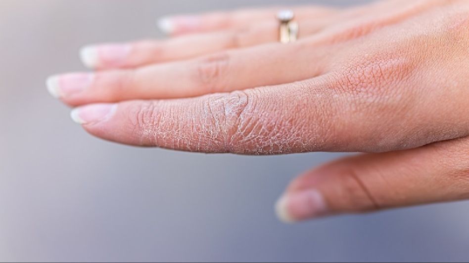 Conquering dryness: A guide to keeping your skin hydrated during the dry season Conquering dryness: A guide to keeping your skin hydrated during the dry season