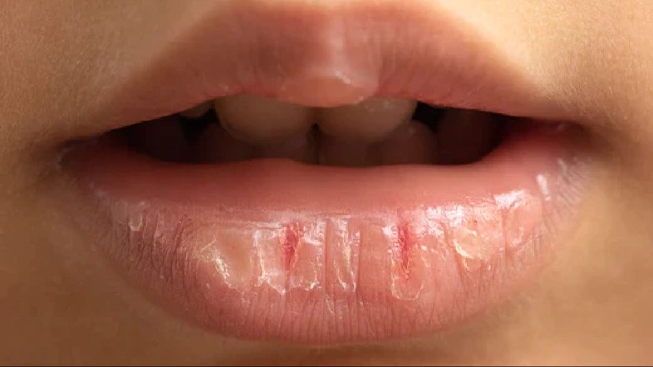 SOS for sore lips: A guide to treating chapped lips at home SOS for sore lips: A guide to treating chapped lips at home