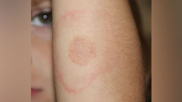 Lyme Disease, Kerala, Ernakulam, Borrelia bacteria, National Institute of Virology, Lisie Hospital, Insect-borne diseases, India