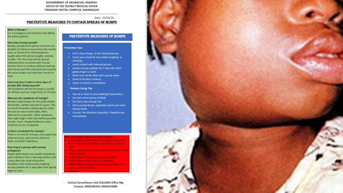 Mumps outbreak, Naharlagun, Twin Capital City, IHIP Portal, health alert