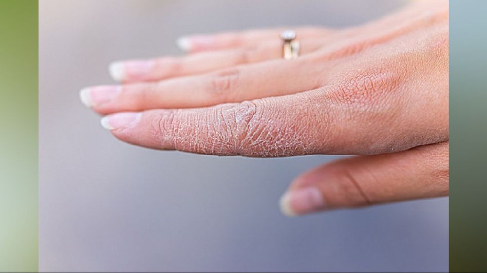 Say goodbye to dry skin: Effective home remedies for soft, hydrated skin Say goodbye to dry skin: Effective home remedies for soft, hydrated skin
