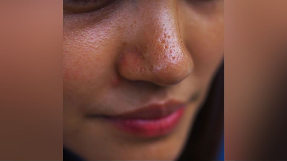 Managing Excess Facial Oil During Summers: Home Remedies and Tips Managing Excess Facial Oil During Summers: Home Remedies and Tips