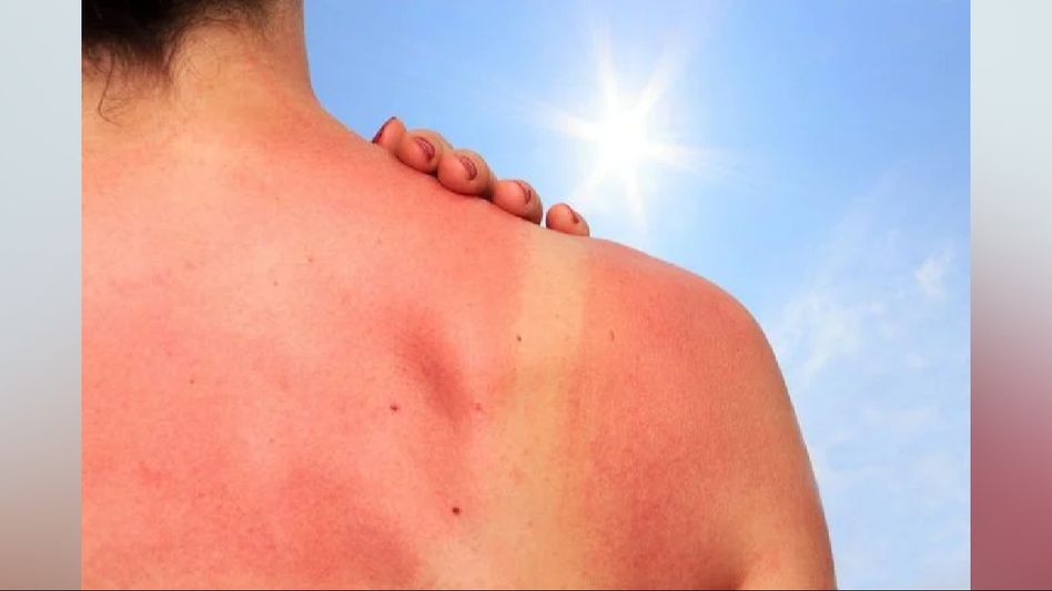 The adverse effects of prolonged sun exposure on skin health The adverse effects of prolonged sun exposure on skin health