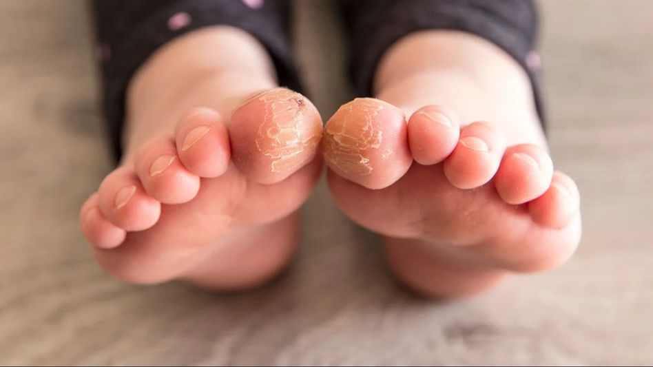 Healing cracked toes: Effective home remedies and prevention tips Healing cracked toes: Effective home remedies and prevention tips