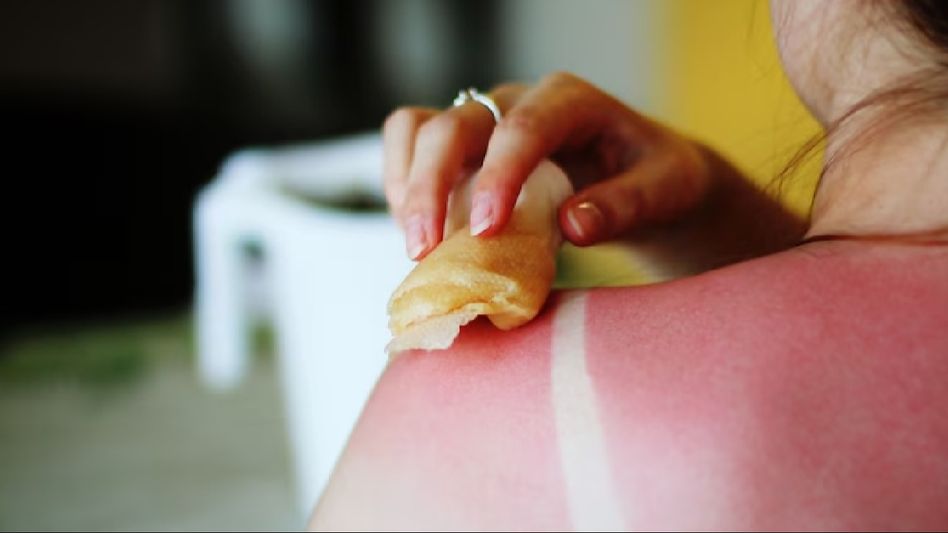 Shielding your skin: A comprehensive guide to preventing sunburn this summer Shielding your skin: A comprehensive guide to preventing sunburn this summer