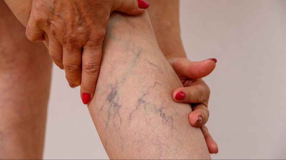 Unveiling varicose veins: Understanding the surge and solutions Unveiling varicose veins: Understanding the surge and solutions