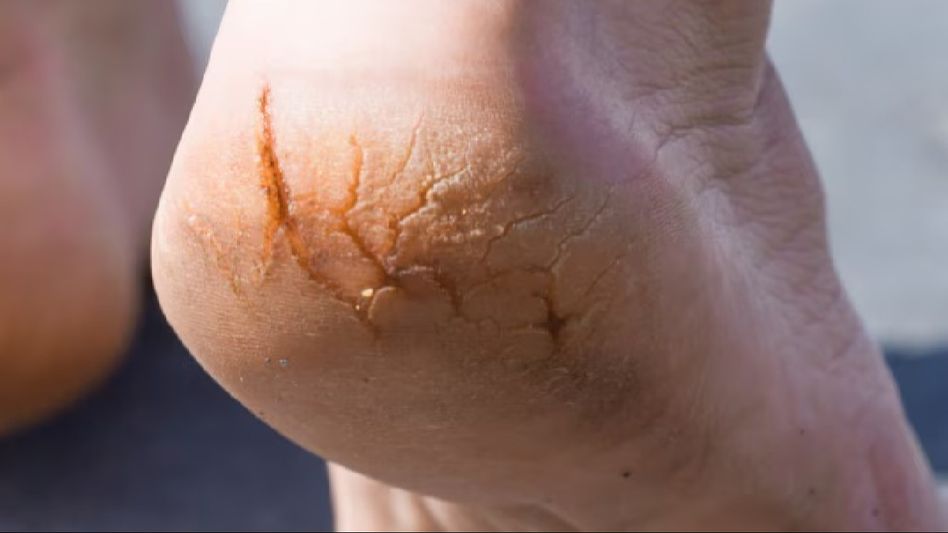 Healing Steps: A Comprehensive Guide to Treating Cracked Feet at Home Healing Steps: A Comprehensive Guide to Treating Cracked Feet at Home